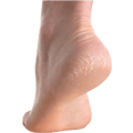 Cracked Feet