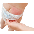 Rashes