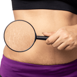 Stretch Marks